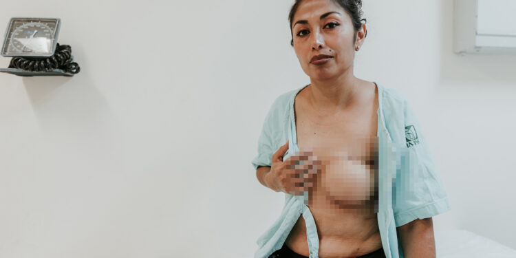 Reconstruyen médicos especialistas del IMSS  Chiapas seno a paciente sobreviviente de  cáncer de mama