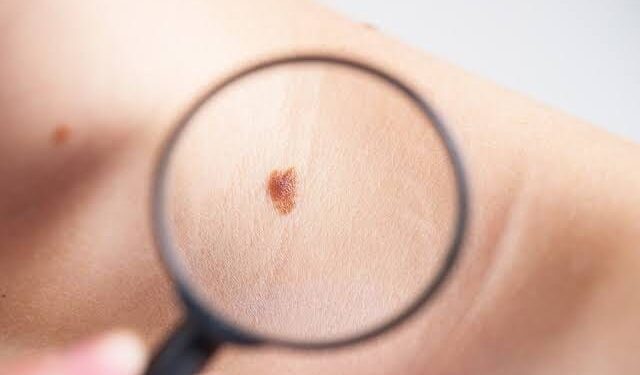 ALERTA SALUD COAHUILA SOBRE EFECTOS DE LOS RAYOS DEL SOL