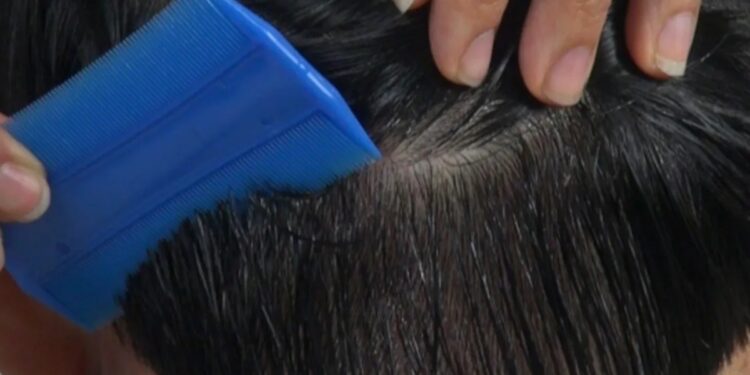 Recomiendan revisión constante a niñas y niños para prevenir propagación de pediculosis