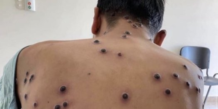 Secretaría de Salud estudia posible caso de viruela del mono en Coahuila