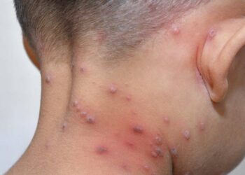 Dos semanas más les dan a alumnos de clases virtuales por brote de varicela