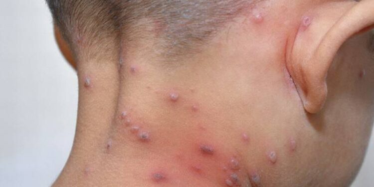 Dos semanas más les dan a alumnos de clases virtuales por brote de varicela