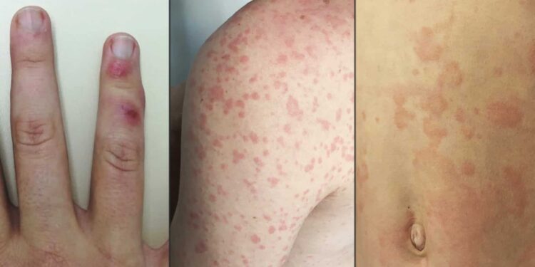 Continúan registrándose casos de Influenza y Varicela en Piedras Negras