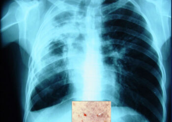 En tratamiento 29 personas por Tuberculosis en Piedras Negras