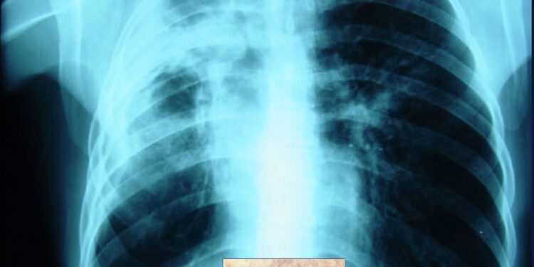 En tratamiento 29 personas por Tuberculosis en Piedras Negras