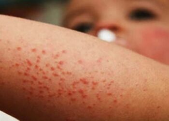 Confirman 21 casos de sarampión en México