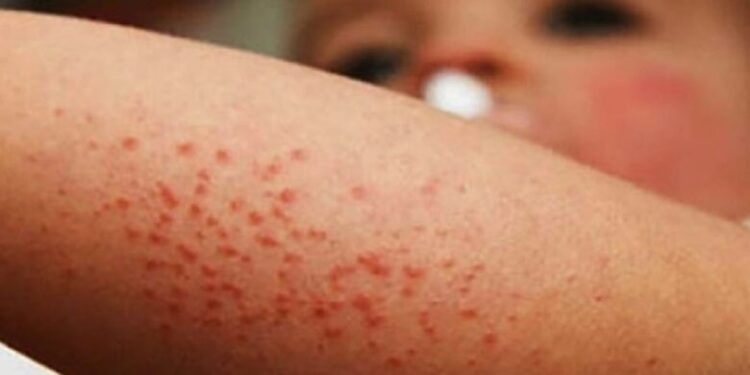 Confirman 21 casos de sarampión en México