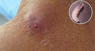 Tercer caso de miasis por gusano barrenador en humanos es detectado