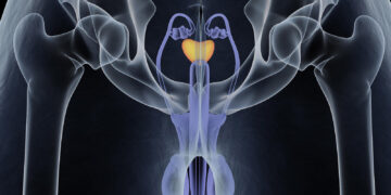 Recomiendan algunos hábitos para para reducir el riesgo de Cáncer de Próstata