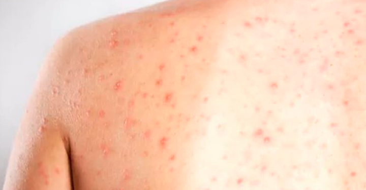 Refuerzan vigilancia sanitaria en Allende tras caso de sarampión vinculado a Acuña